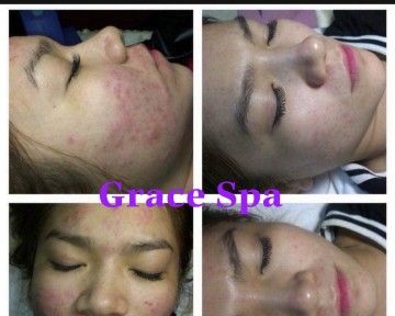 KHÁCH HÀNG  VÕ TRÂM ANH 32 TUỔI SỐNG TẠI TP. THUẬN AN - BÌNH DƯƠNG  ĐIỀU TRỊ  MỤN  SAU 1 TUẦN